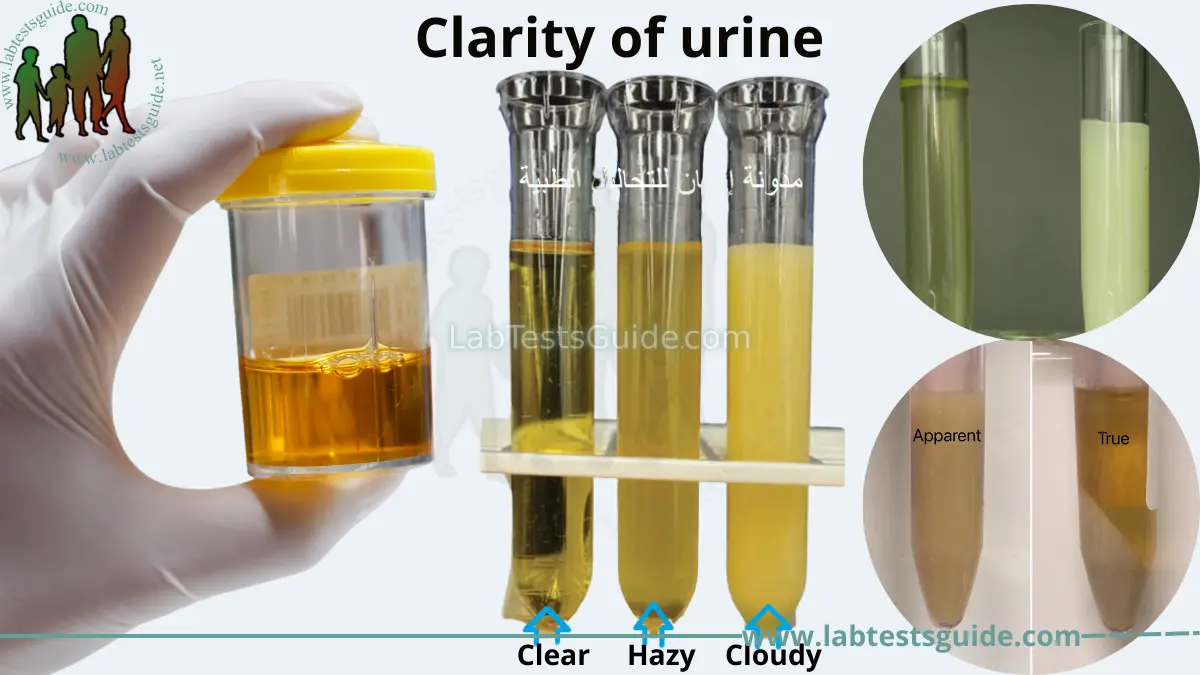 Urine Appearance Causes, Symptoms, Treatment, and Prevention Lab