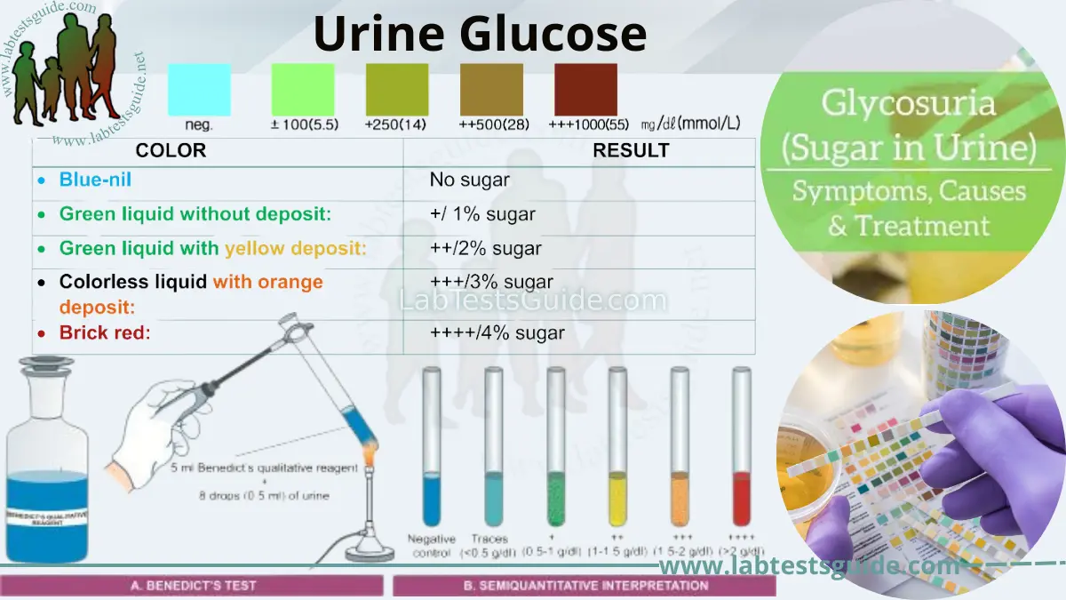 Urine Glucose Test Purpose, Procedure, Results, and Interpretation